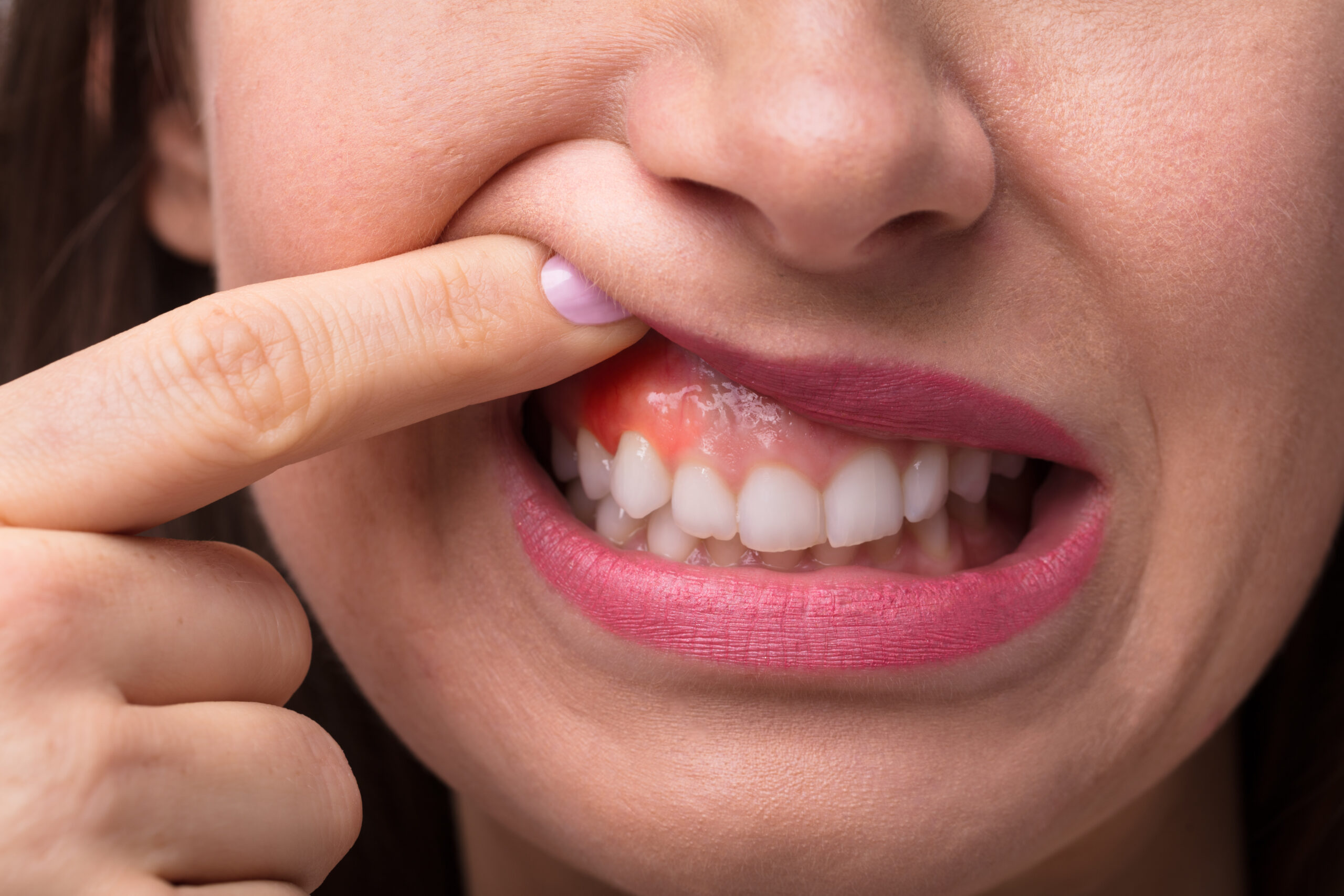 The image is a close up of a woman showing swelling on her gums to introduce tips for maintaining gum health.