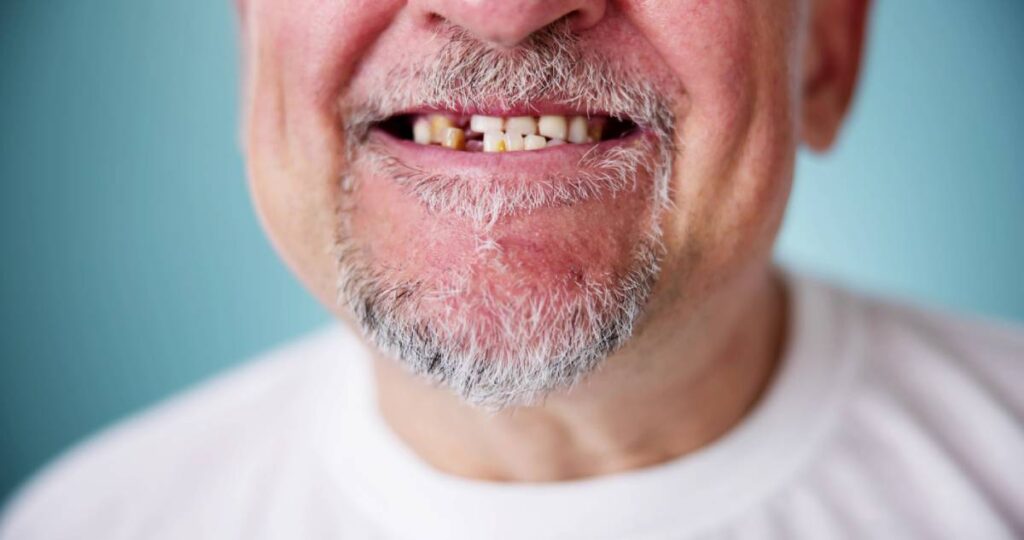 Can You Get Dental Implants If You Have Periodontal Disease East