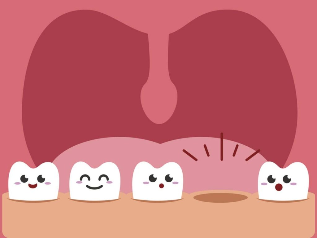 Illustration of mouth with a missing tooth.