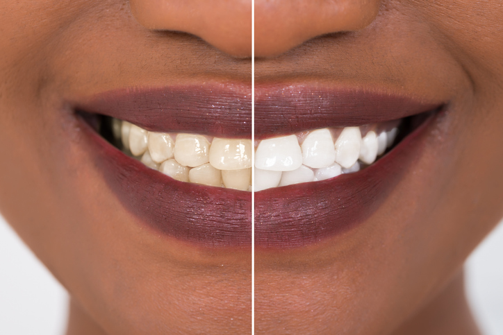 Featured image for Should You Undergo Regular Teeth Whitening