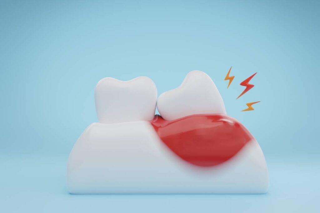 visual signs your wisdom teeth are infected